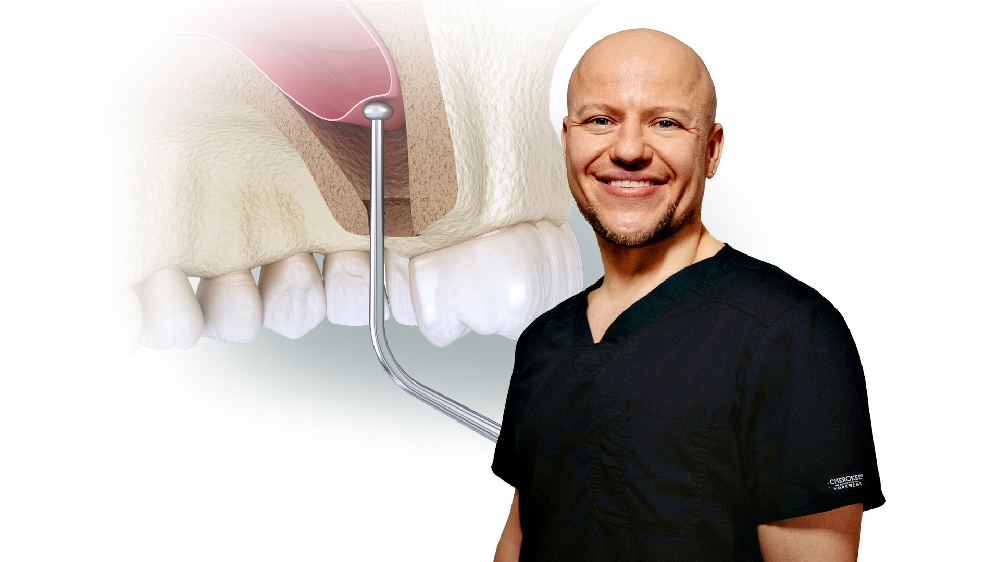 Осложнения при синус-лифтинге: профилактика и лечение