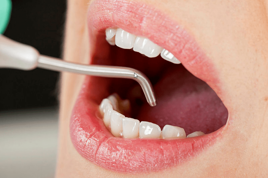 Профессиональная чистка зубов с помощью AIR FLOW