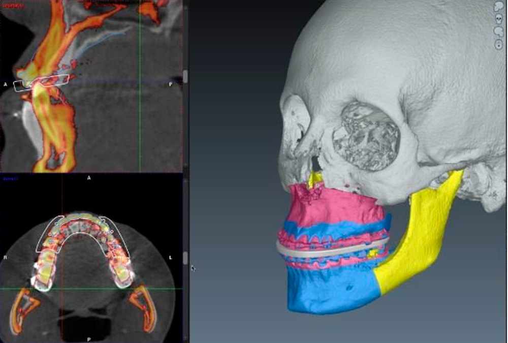 Как использовать модуль CMF Surgery, Romexis 6.2