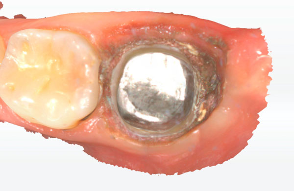 Gingivotomiya_pri_skanirovanii_gluboko_razrushennykh_zubov.jpg Gingivotomiya_pri_skanirovanii_gluboko_razrushennykh_zubov.jpg