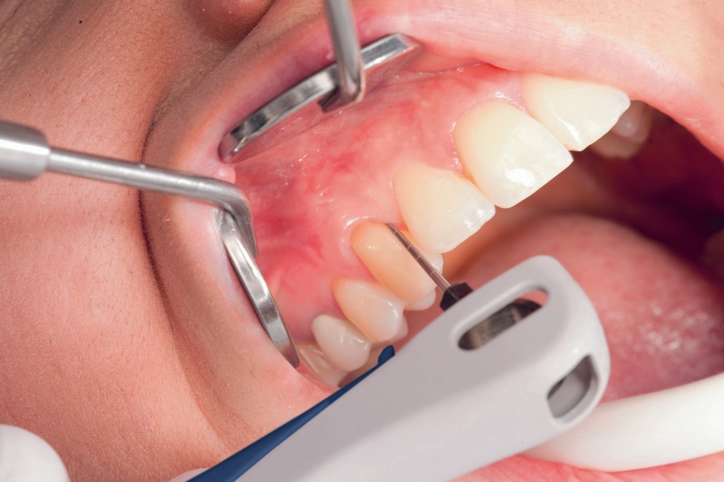 Лечение зубов аппаратом Vector.jpg