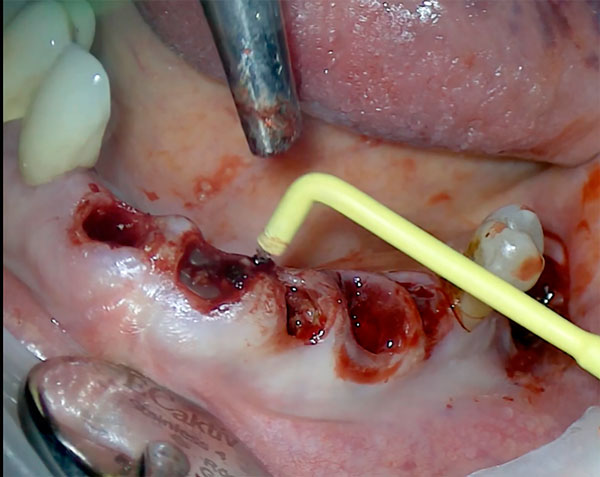 Etapy_raboty_pri_elektrokyuretazhe_granulyatsiy_posle_udaleniya_zubov.jpg Etapy_raboty_pri_elektrokyuretazhe_granulyatsiy_posle_udaleniya_zubov.jpg