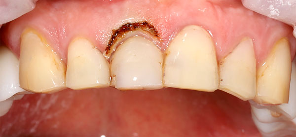 Gingivotomiya_dlya_vyravnivaniya_zenitov_koronok_zubov.jpg Gingivotomiya_dlya_vyravnivaniya_zenitov_koronok_zubov.jpg